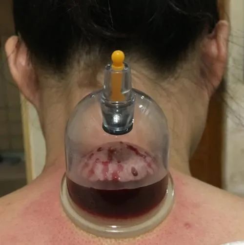 Immediate Effects of Bloodletting Therapy