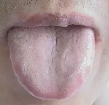 The Most Comprehensive Guide to Tongue Diagnosis! Master It and Become a Tongue Diagnosis Expert