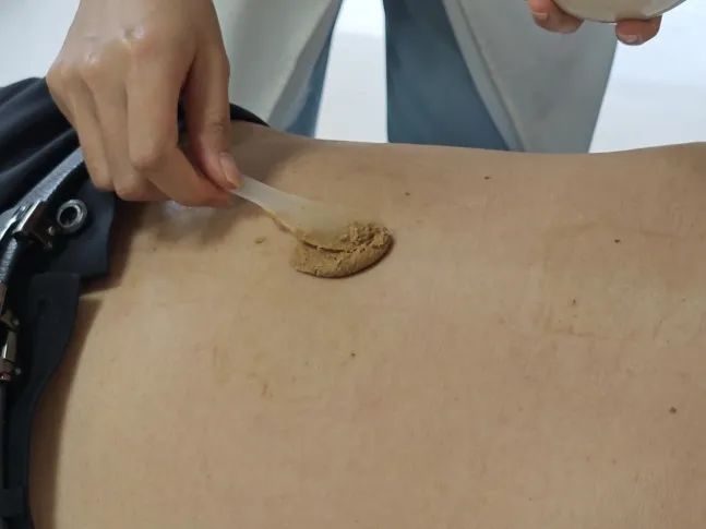 Traditional Chinese Medicine Therapy: Warming Yang Cupping