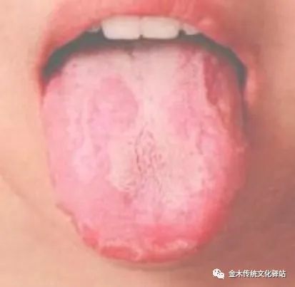 Tongue Diagnosis in Traditional Chinese Medicine: Characteristics of Tongue Coating