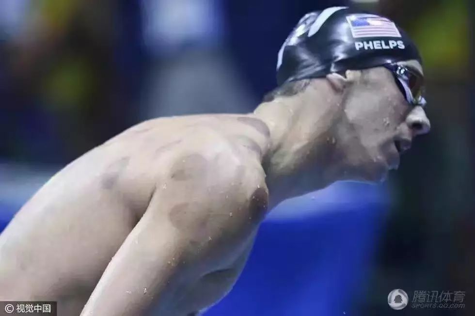 Cupping Therapy Shines at the Rio Olympics
