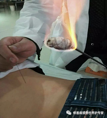 Fire Needle: An Evolution in Acupuncture Therapy