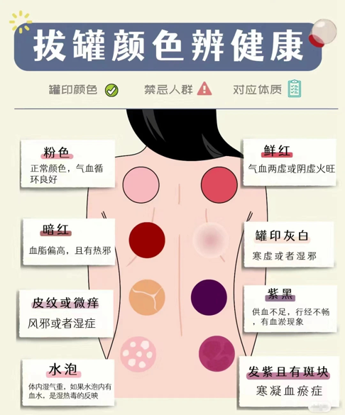 TCM Nursing Techniques: The Unique Balance Cupping Therapy