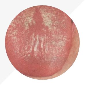 Understanding Tongue Diagnosis in TCM: Insights into Health from Tongue Appearance (Part 2)