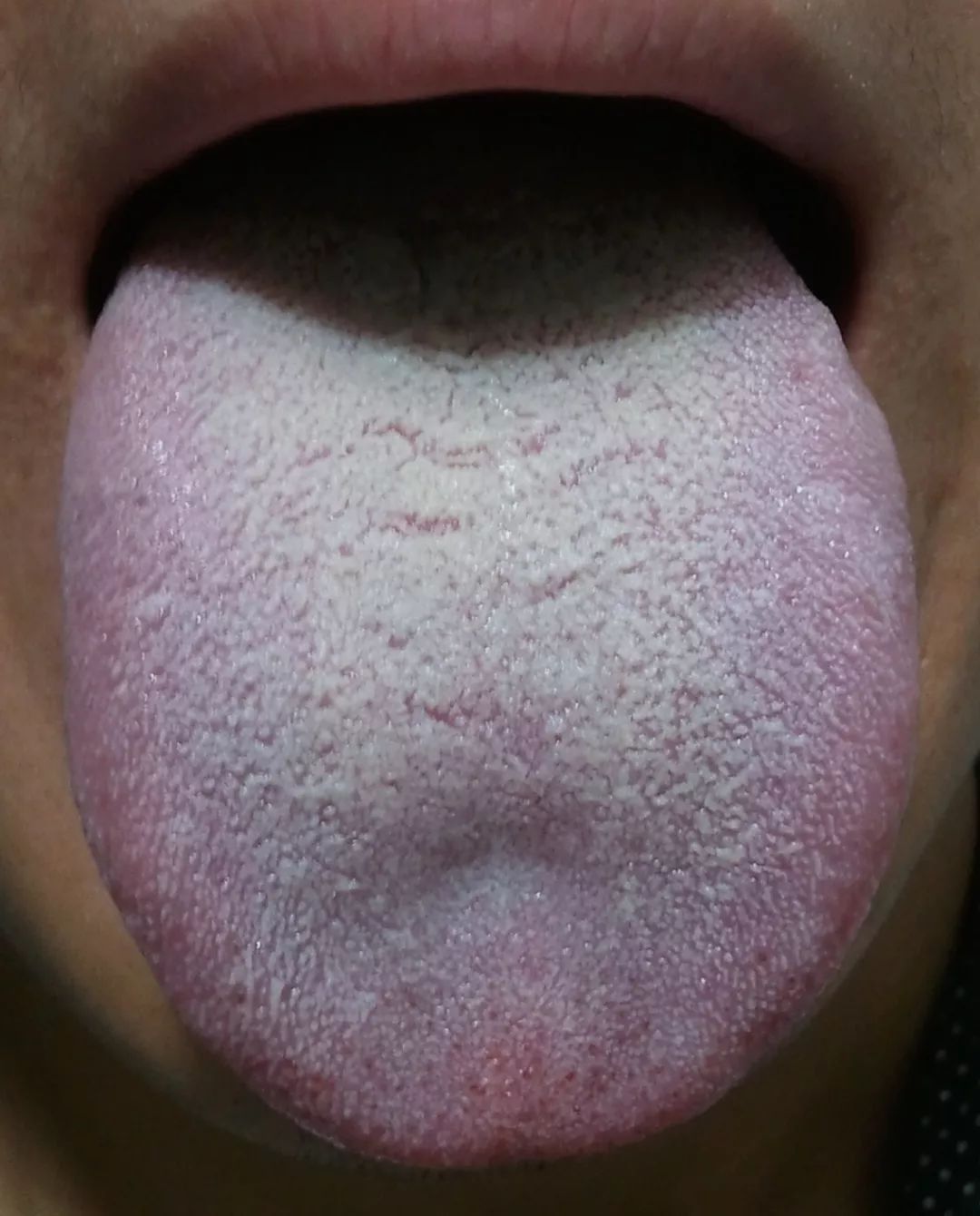 Diagnosis and Health Preservation of Phlegm-Damp Constitution