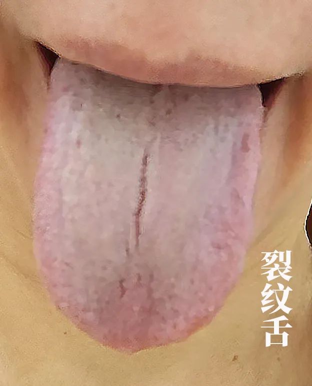 The Body Signals Illness: Understanding Tongue Diagnosis in TCM