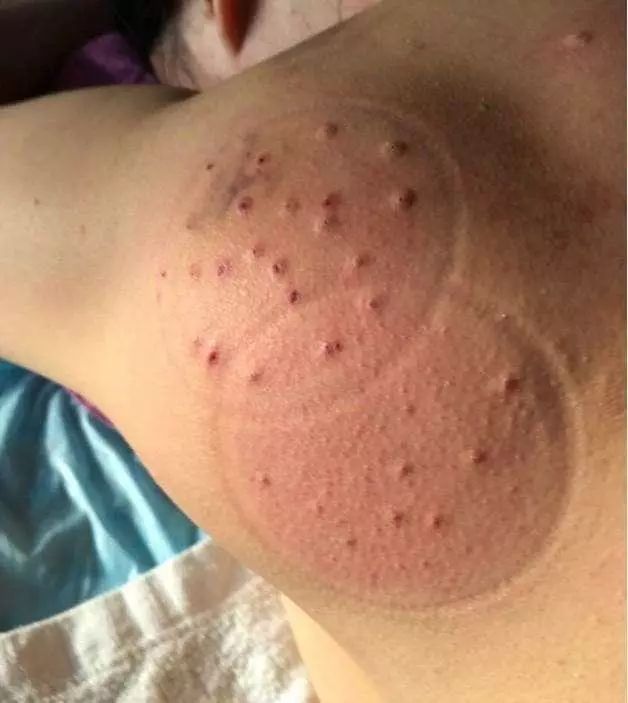 Fire Needle Therapy for Large Lipomas