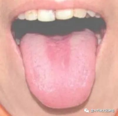 Tongue Diagnosis in Traditional Chinese Medicine: Characteristics of Tongue Coating