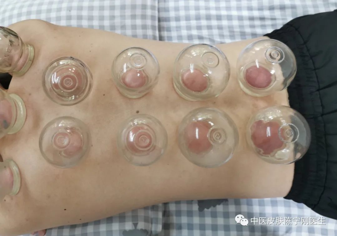 Cupping Therapy: A Traditional Method for Moisture Removal