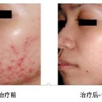 Fire Needle Therapy for Skin Diseases: Visible Safety and Efficacy