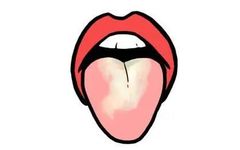 Should You Scrape Yellow and Thick Tongue Coating? Find Out Here