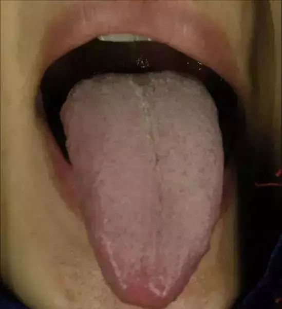 The Most Comprehensive Guide to Tongue Diagnosis! Master It and Become a Tongue Diagnosis Expert