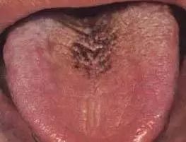 Understanding Tongue Diagnosis in Traditional Chinese Medicine (with Tongue Diagnosis Illustrations)