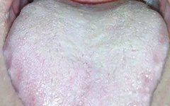 Four Tongue Coating Colors Revealing Your Body Condition!