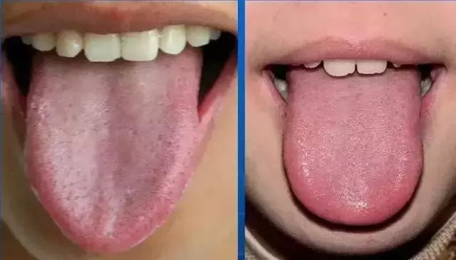 The Most Comprehensive Guide to Tongue Diagnosis! Master It and Become a Tongue Diagnosis Expert