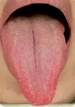 Understanding the State of Organs and Qi-Blood Dynamics Through Tongue Diagnosis
