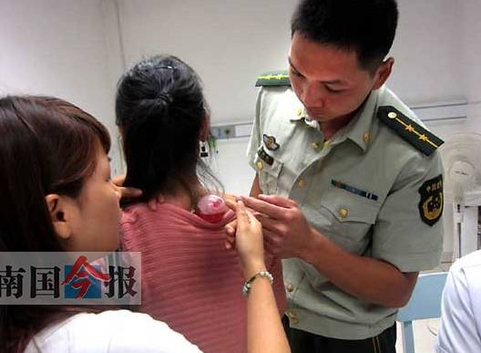 The Benefits of Bloodletting Therapy in Traditional Chinese Medicine
