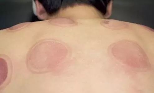 A Comprehensive Guide to Cupping Therapy