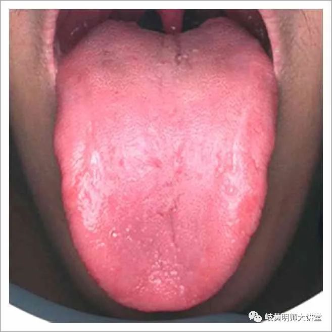 Traditional Chinese Medicine Tongue Diagnosis: Illustrated Guide to 14 Types of Tongue Shapes and Qualities
