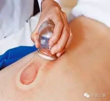 Cupping Therapy: An Art of Healing
