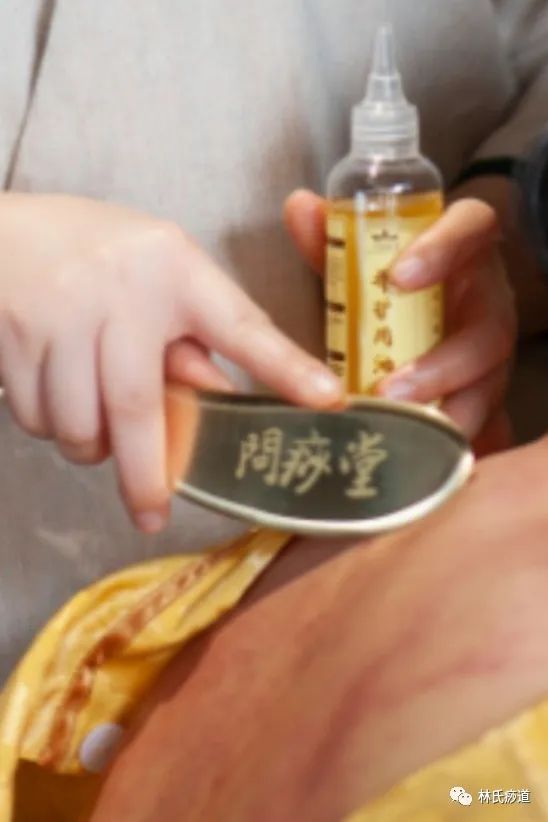 Key Points of Gua Sha