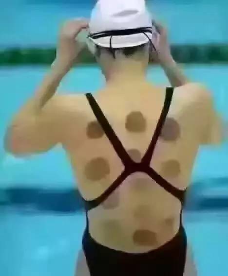 Cupping Therapy Shines at the Rio Olympics