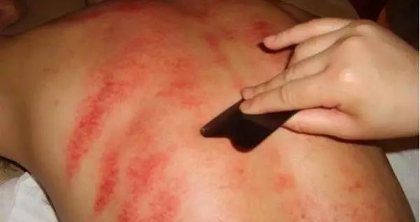 Analysis of Guasha Marks: Reflecting Different Health Conditions!