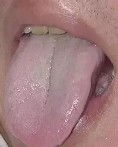 The Most Comprehensive Guide to Tongue Diagnosis! Master It and Become a Tongue Diagnosis Expert