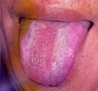 The Most Comprehensive Guide to Tongue Diagnosis! Master It and Become a Tongue Diagnosis Expert