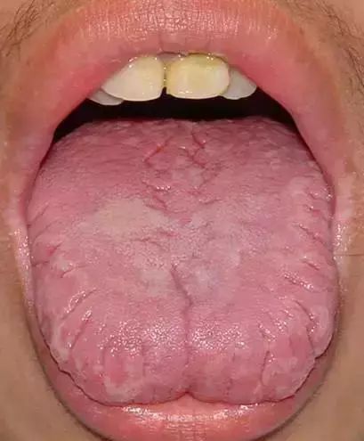 The Most Comprehensive Guide to Tongue Diagnosis! Master It and Become a Tongue Diagnosis Expert