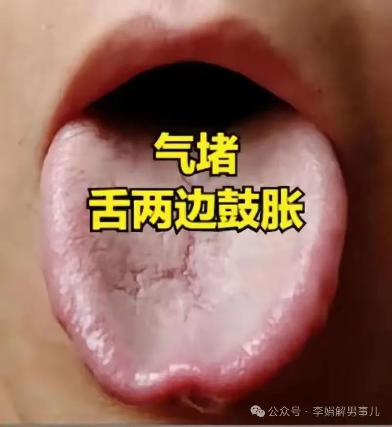 Three Tongue Manifestations Men Fear Most: Liver Qi Stagnation, Blood Stasis, and Phlegm-Dampness!