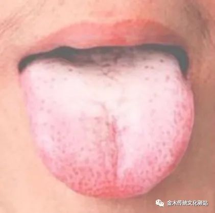 Tongue Diagnosis in Traditional Chinese Medicine: Tongue Coating