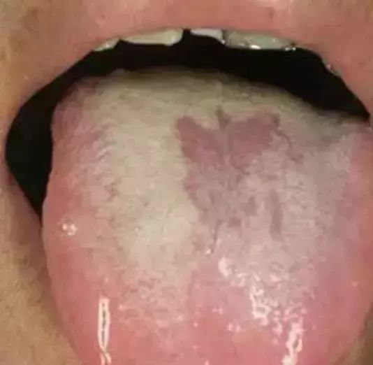The Most Comprehensive Guide to Tongue Diagnosis! Master It and Become a Tongue Diagnosis Expert