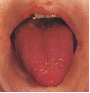 61 High-Definition Tongue Diagnosis Charts with Visual Comparisons
