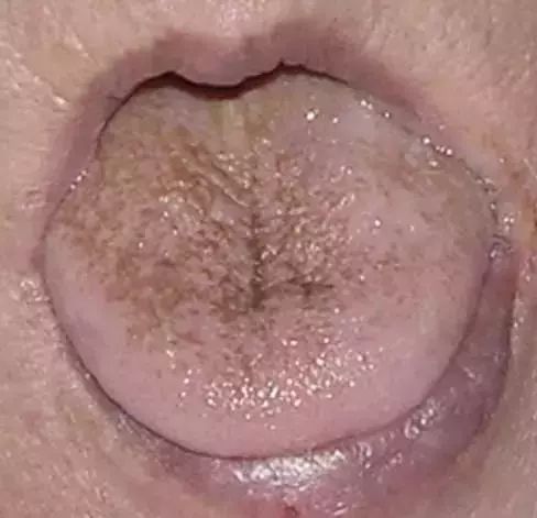 The Most Comprehensive Guide to Tongue Diagnosis! Master It and Become a Tongue Diagnosis Expert