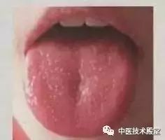 Tongue Diagnosis: Issues Revealed and Simple TCM Remedies