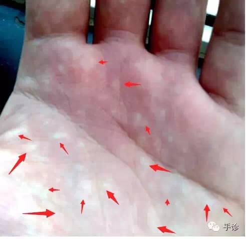 Eight Principles of Hand Diagnosis Based on Color Observation (Must-Collect)