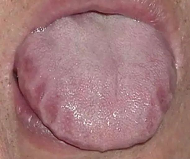Tongue Diagnosis - Illustrated Guide to Tongue Manifestations