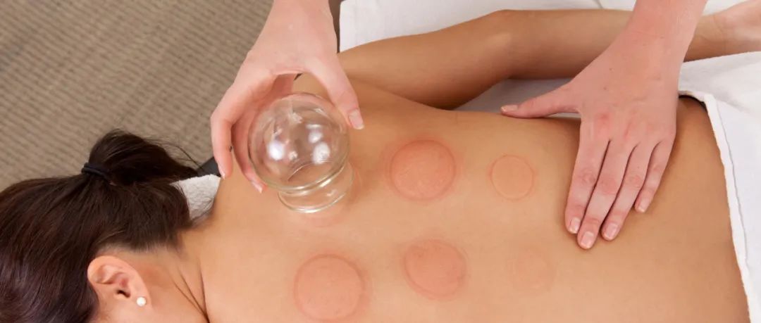 Understanding 'Heat': The Benefits of Cupping Therapy in Summer