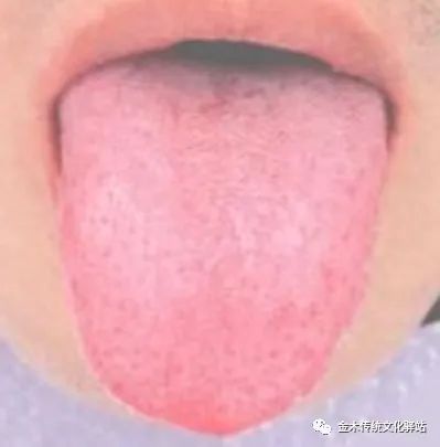 Tongue Diagnosis in Traditional Chinese Medicine: Characteristics of Tongue Coating