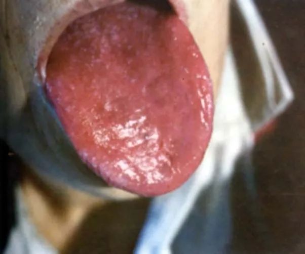 The Health Code Hidden on Your Tongue