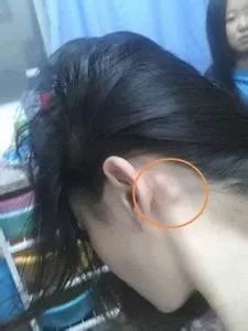 Diagnosis and Health Preservation of Phlegm-Damp Constitution