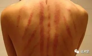 Fundamentals of Gua Sha: Methods and Precautions
