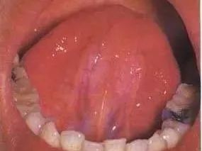Understanding Tongue Diagnosis in Traditional Chinese Medicine (with Tongue Diagnosis Illustrations)