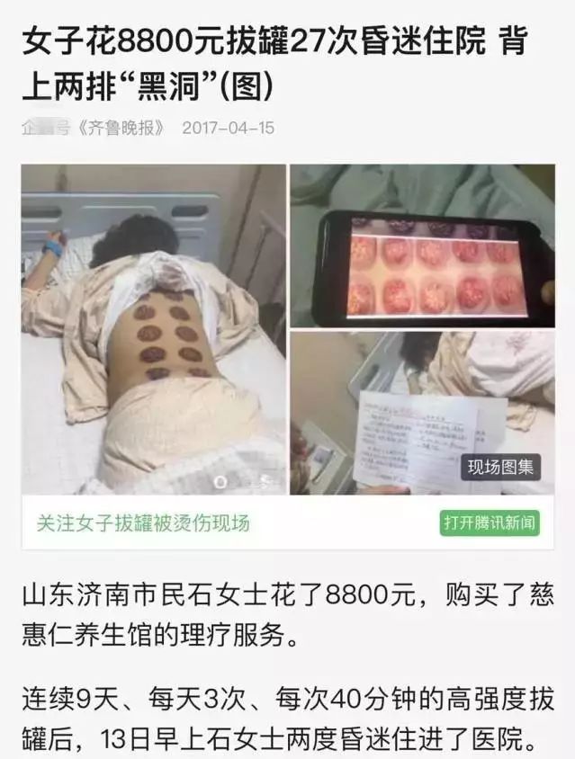 Man Gets Stuck in Cupping Therapy! Firefighters Called for Rescue... Would You Dare to Try It?