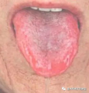 Tongue Diagnosis in Traditional Chinese Medicine: Characteristics of Tongue Coating