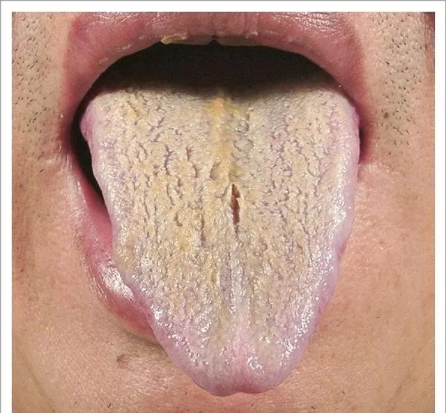 Traditional Chinese Medicine Tongue Diagnosis: 26 Clinical High-Definition Tongue Diagnosis Images with Analysis