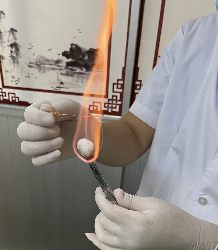 Fire Needle Therapy: Supporting Yang and Expelling Pathogens (Issue 10)
