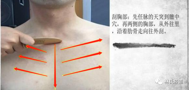 Key Points of Gua Sha