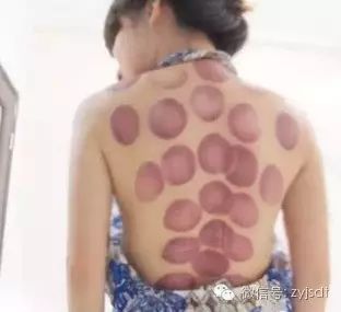 What Happens After Cupping? Stop Asking and Find the Answers Yourself